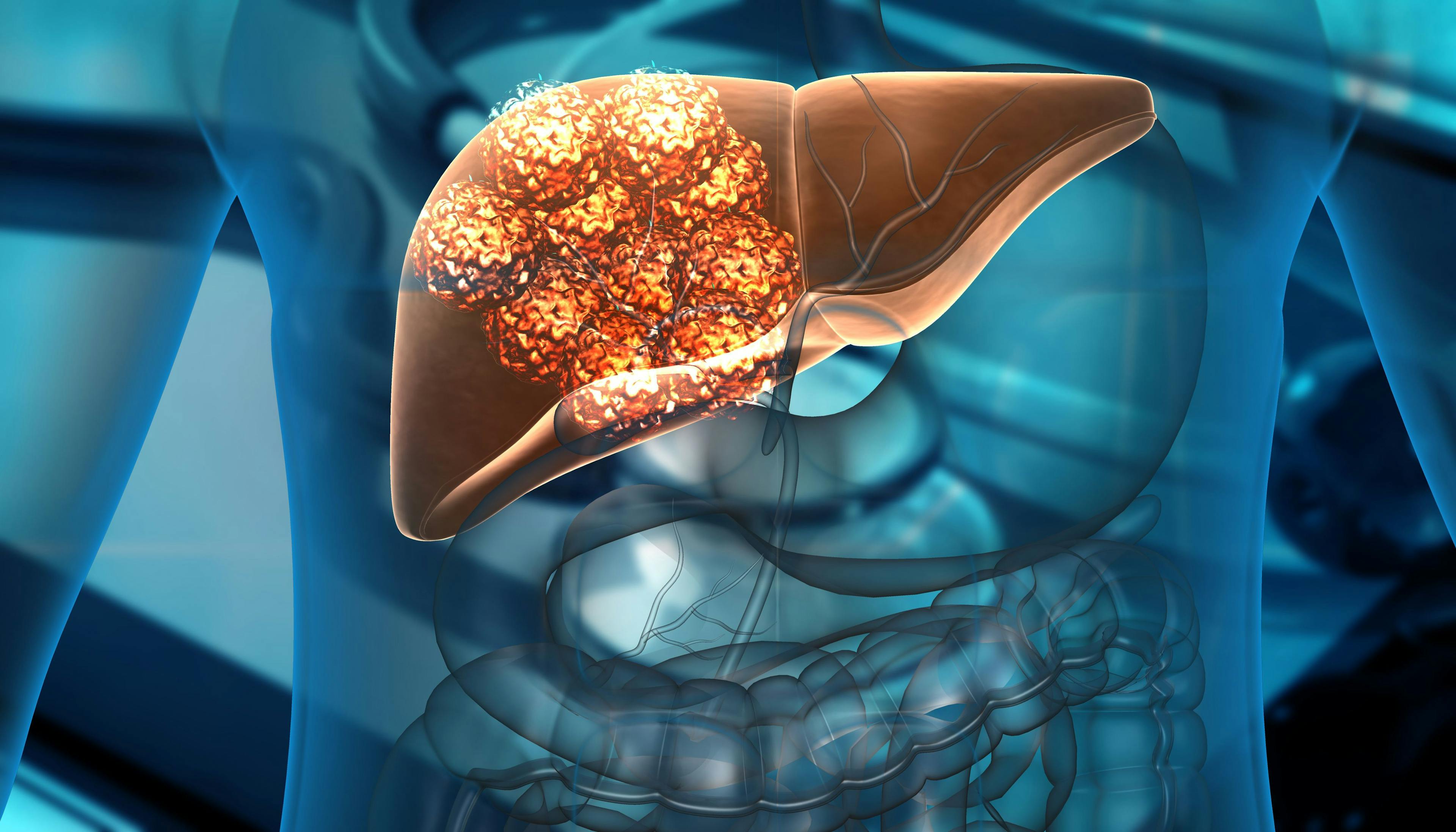 FDA Grants Fast Track Designation to Tumor-Infiltrating Lymphocyte Therapy for Liver Cancer