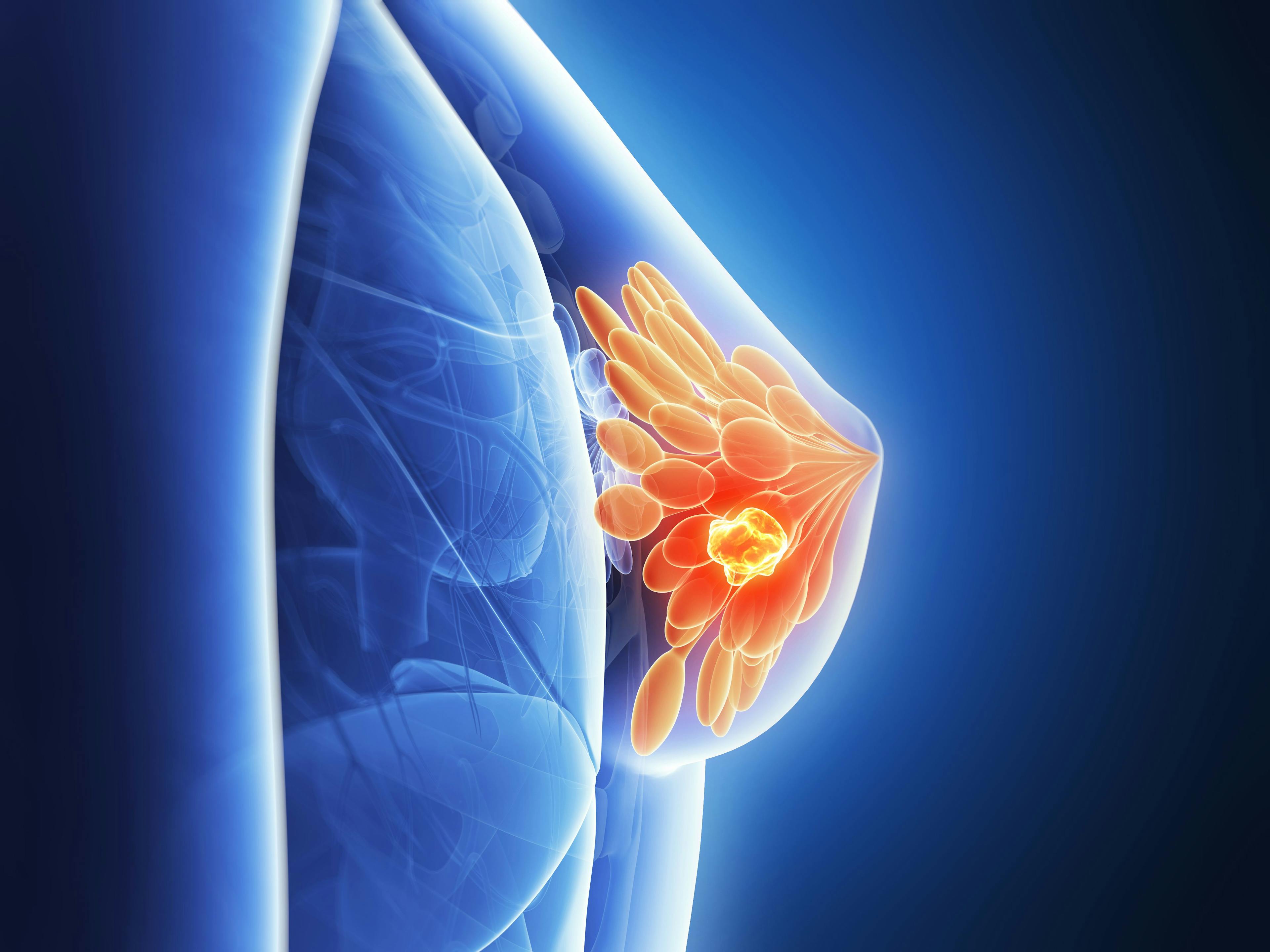 Truqap Combination Approved by FDA for HR-Positive, HER2-Negative Locally Advanced, Metastatic Breast Cancer