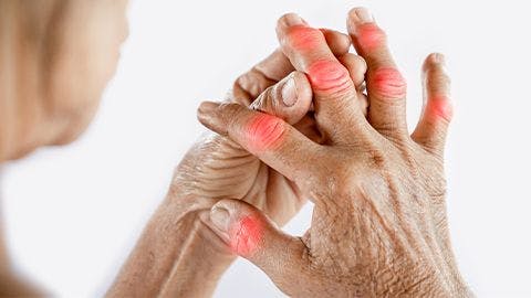 Treating Rheumatoid Arthritis Patients With Biosimilars Versus Leflunomide: An Economic Evaluation